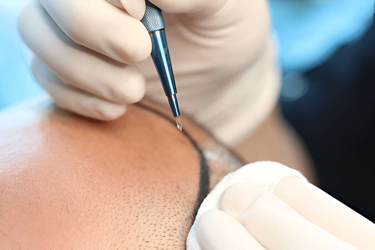 hair transplant London