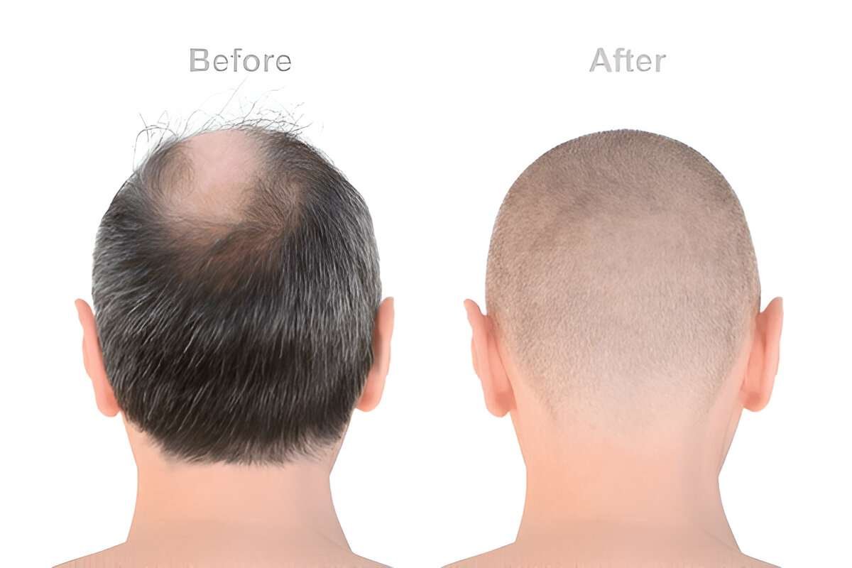 hair transplant UK