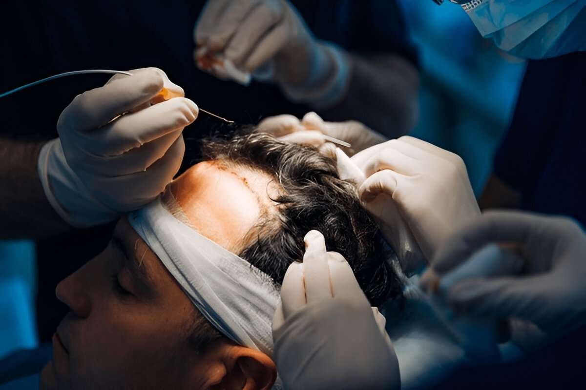 hair transplant uk