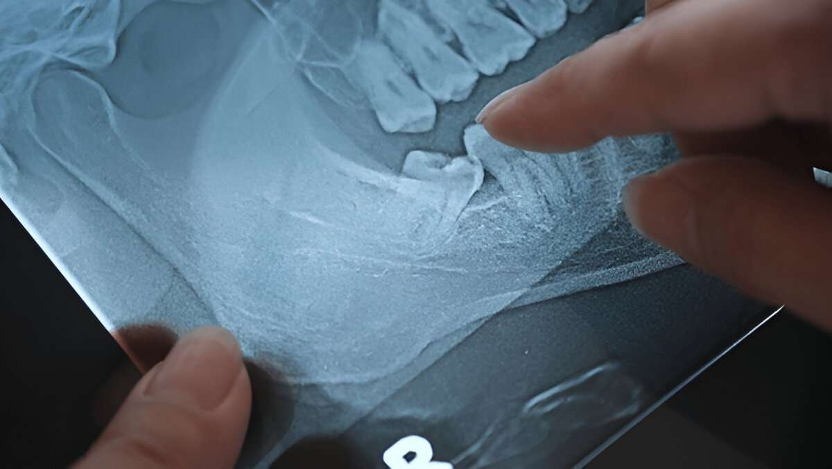 Impacted wisdom teeth