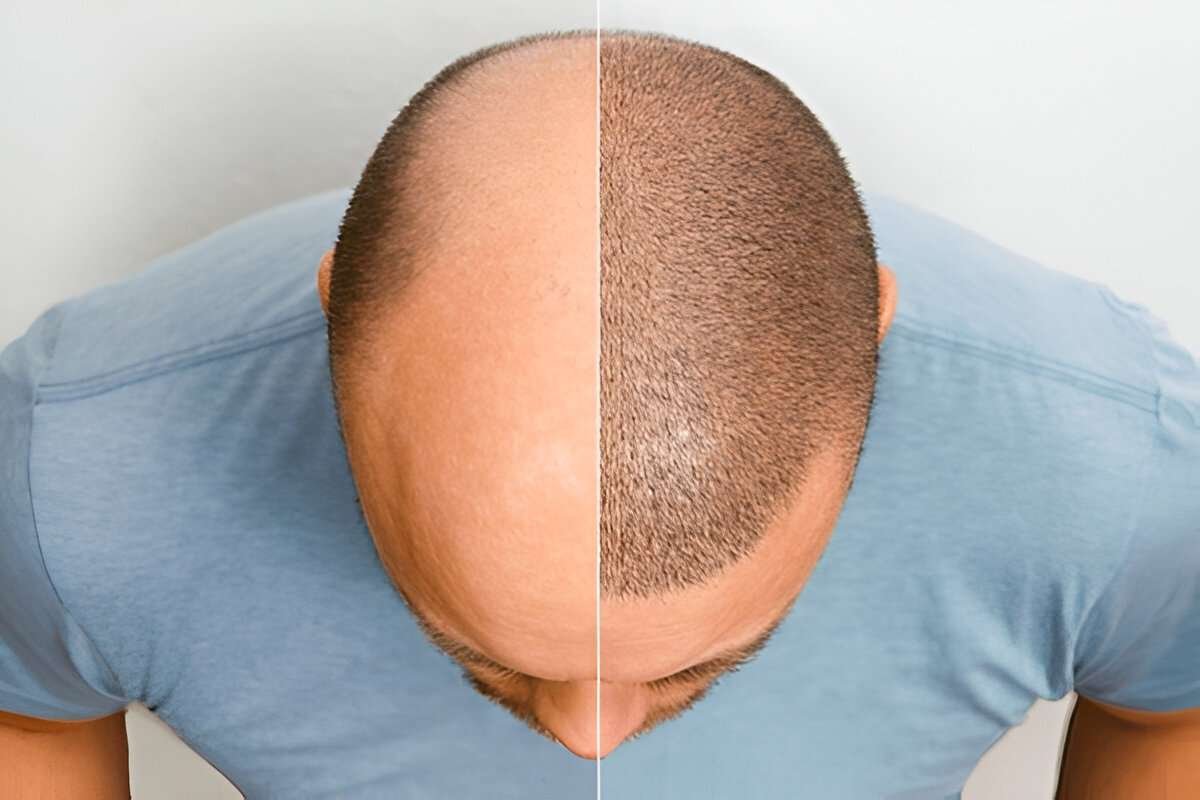hair transplant Cardiff