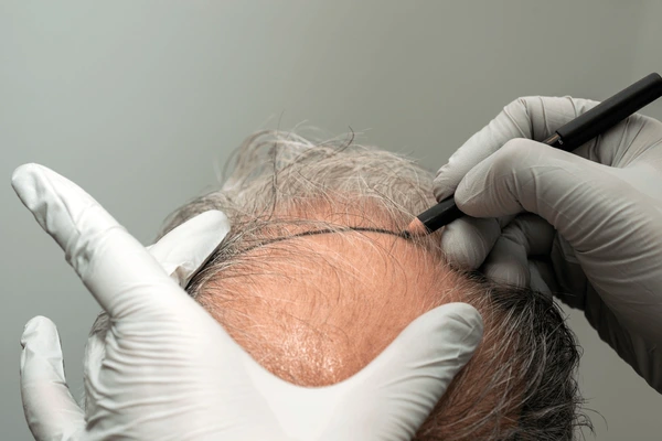 hair transplant