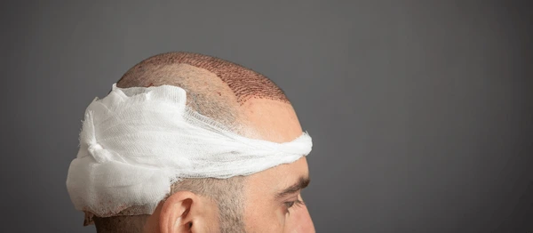 hair loss treatment