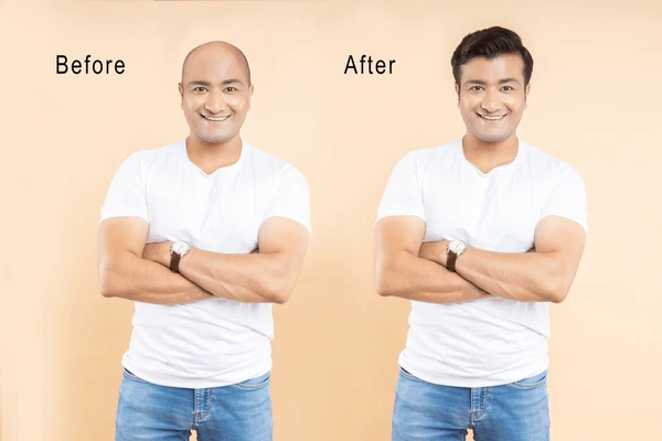 hairloss treatment