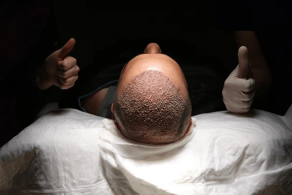 Jude Law hair transplant