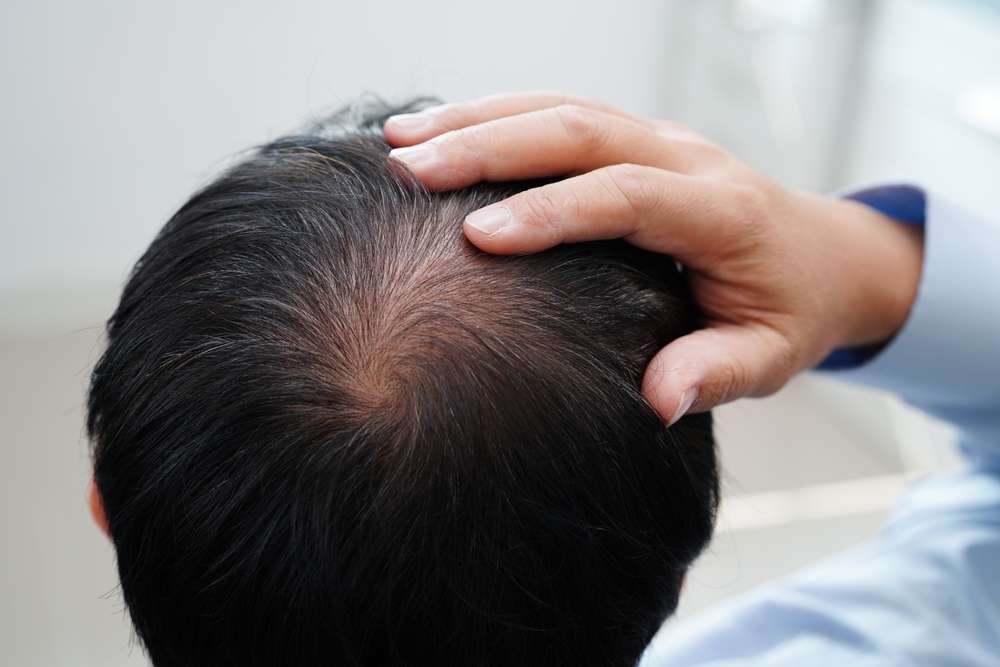 scalp Pigmentation