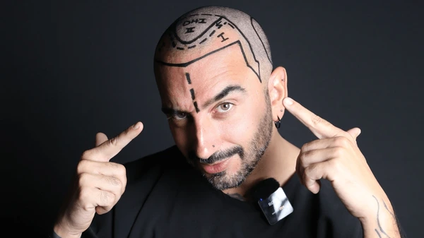 bad hairline