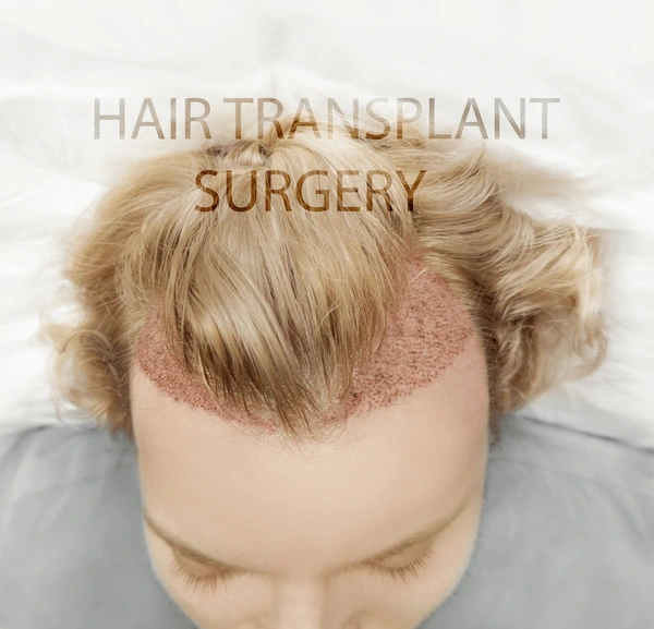 justin bieber hair transplant before and after