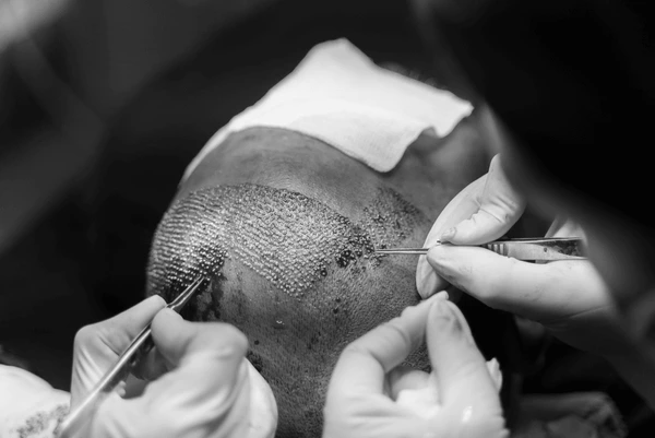 oral minoxidil UK