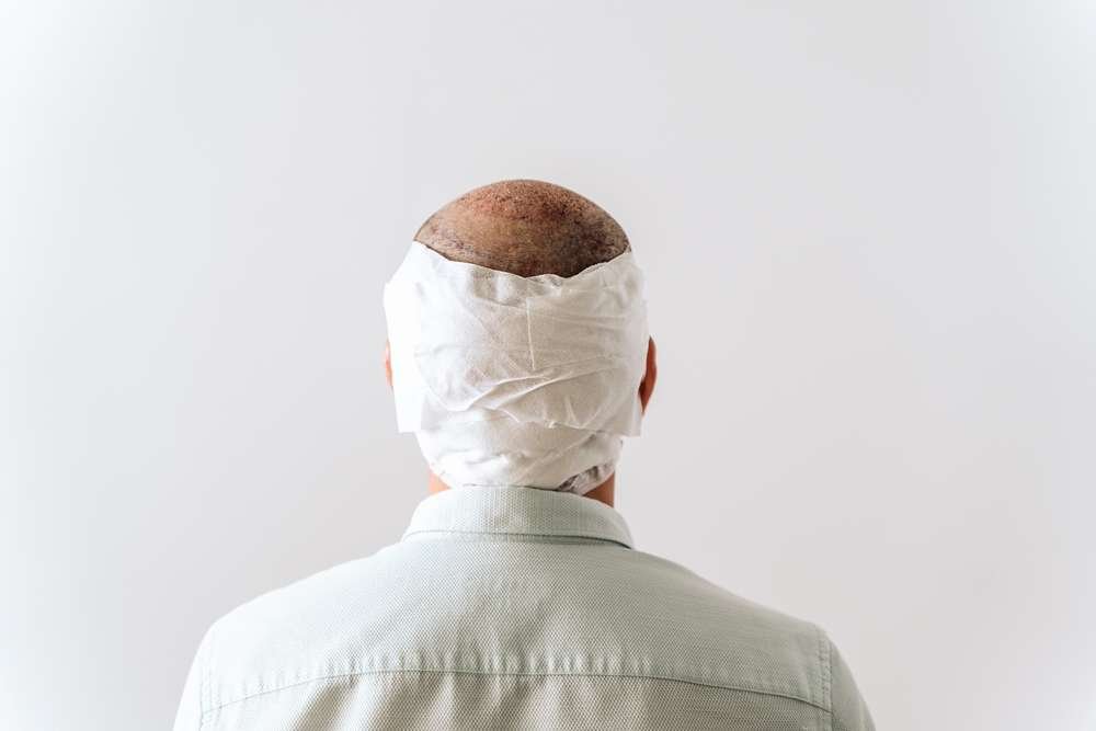 rob brydon hair transplant