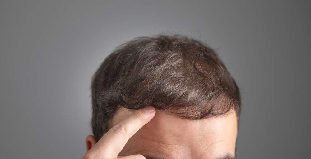 oral minoxidil before and after